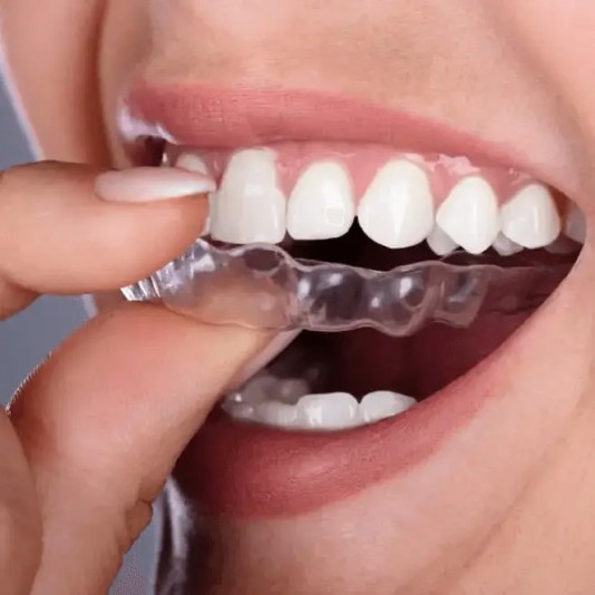 Tratamiento con alineadores transparentes Invisalign en Miami